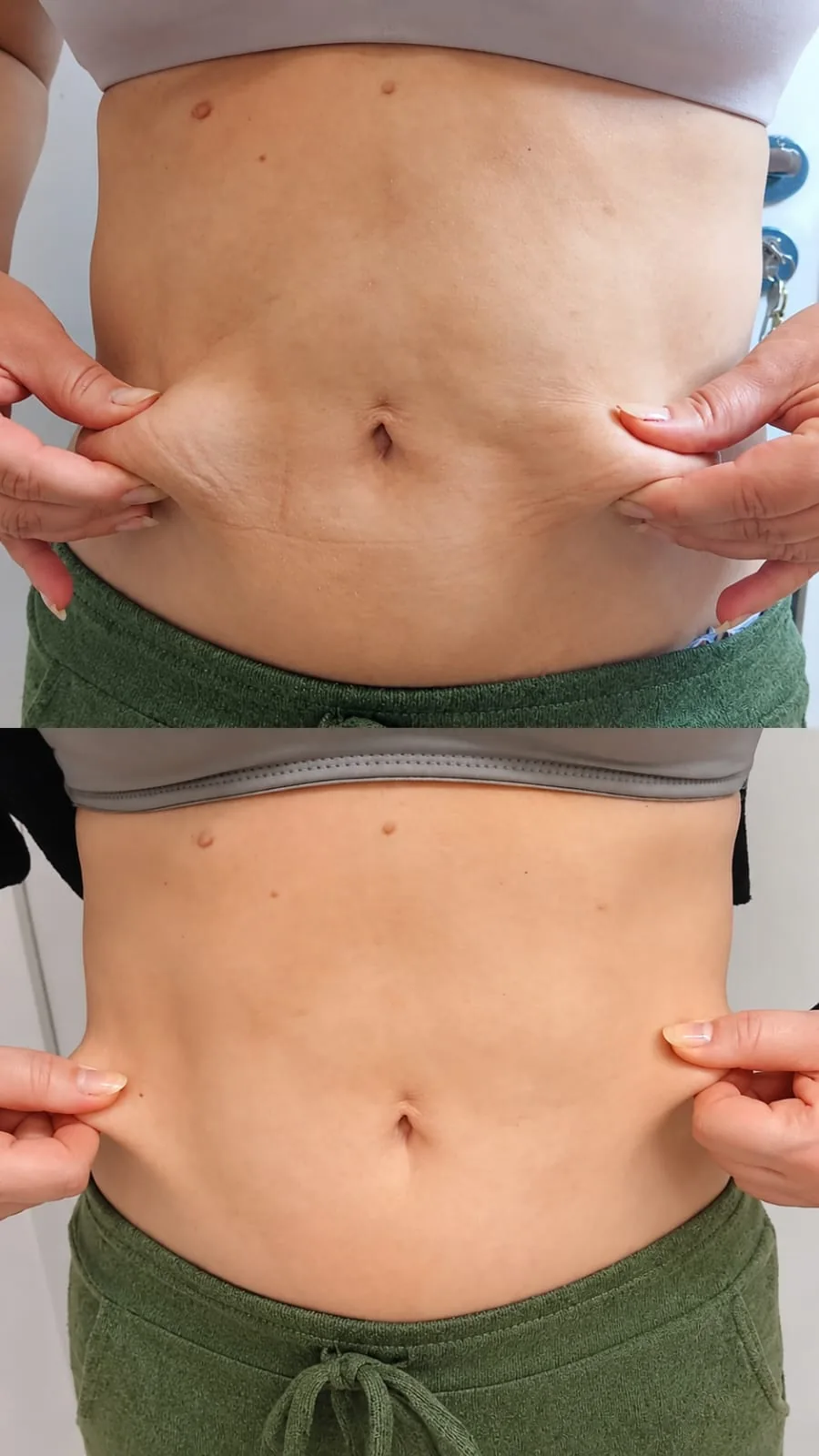 Antes e depois de tratamento para gordura localizada