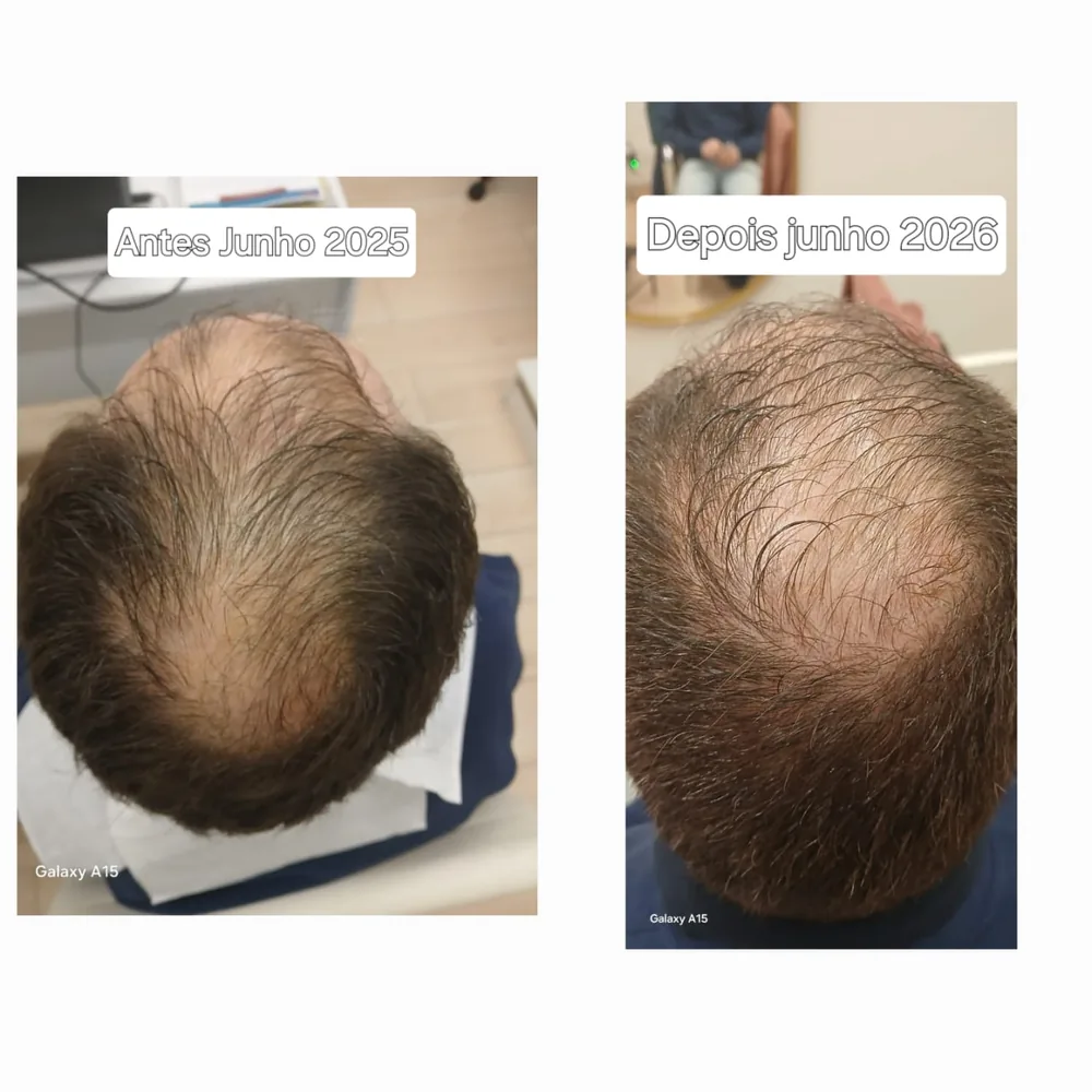 Antes e depois de tratamento capilar