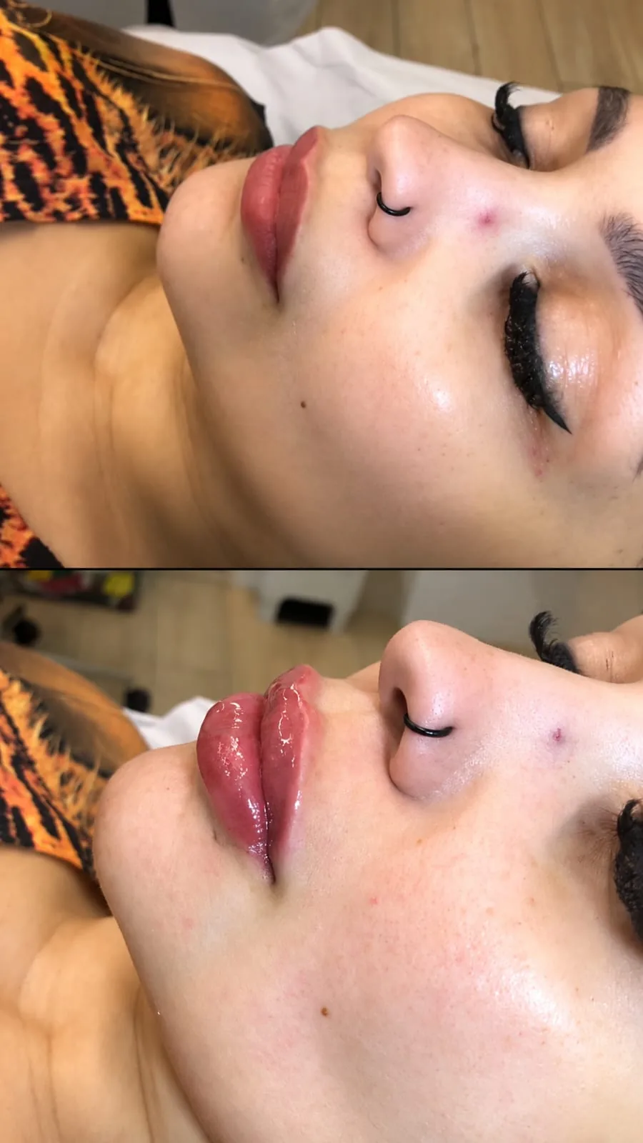 Antes e depois de preenchimento labial