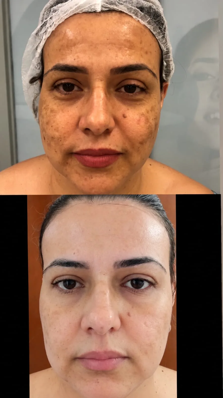 Antes e depois de tratamento de melasma