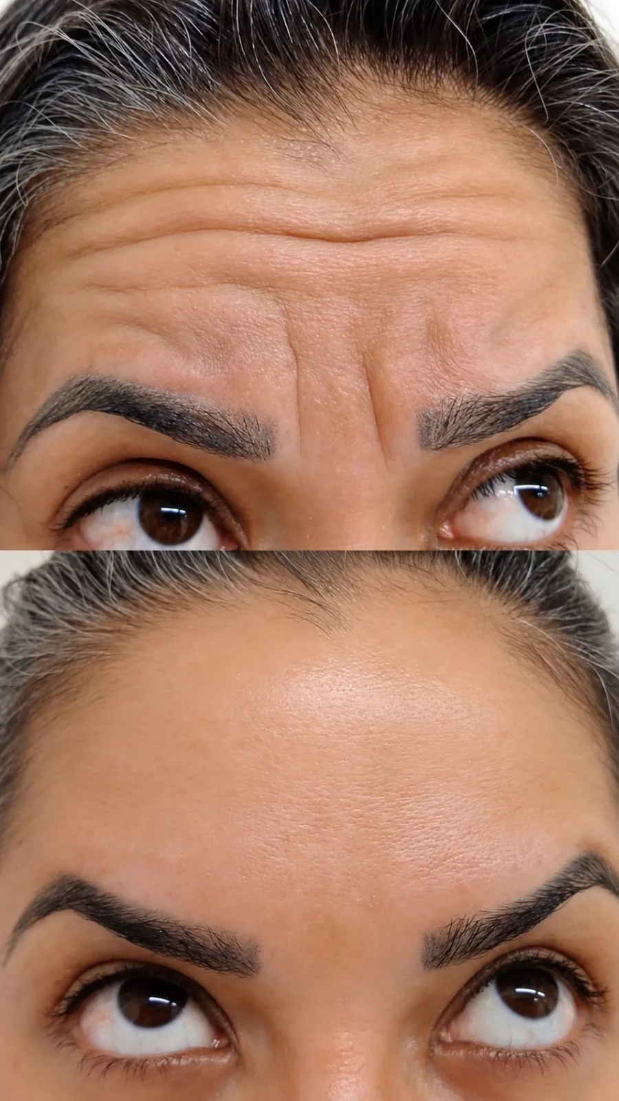 Antes e depois de toxina botulínica na testa
