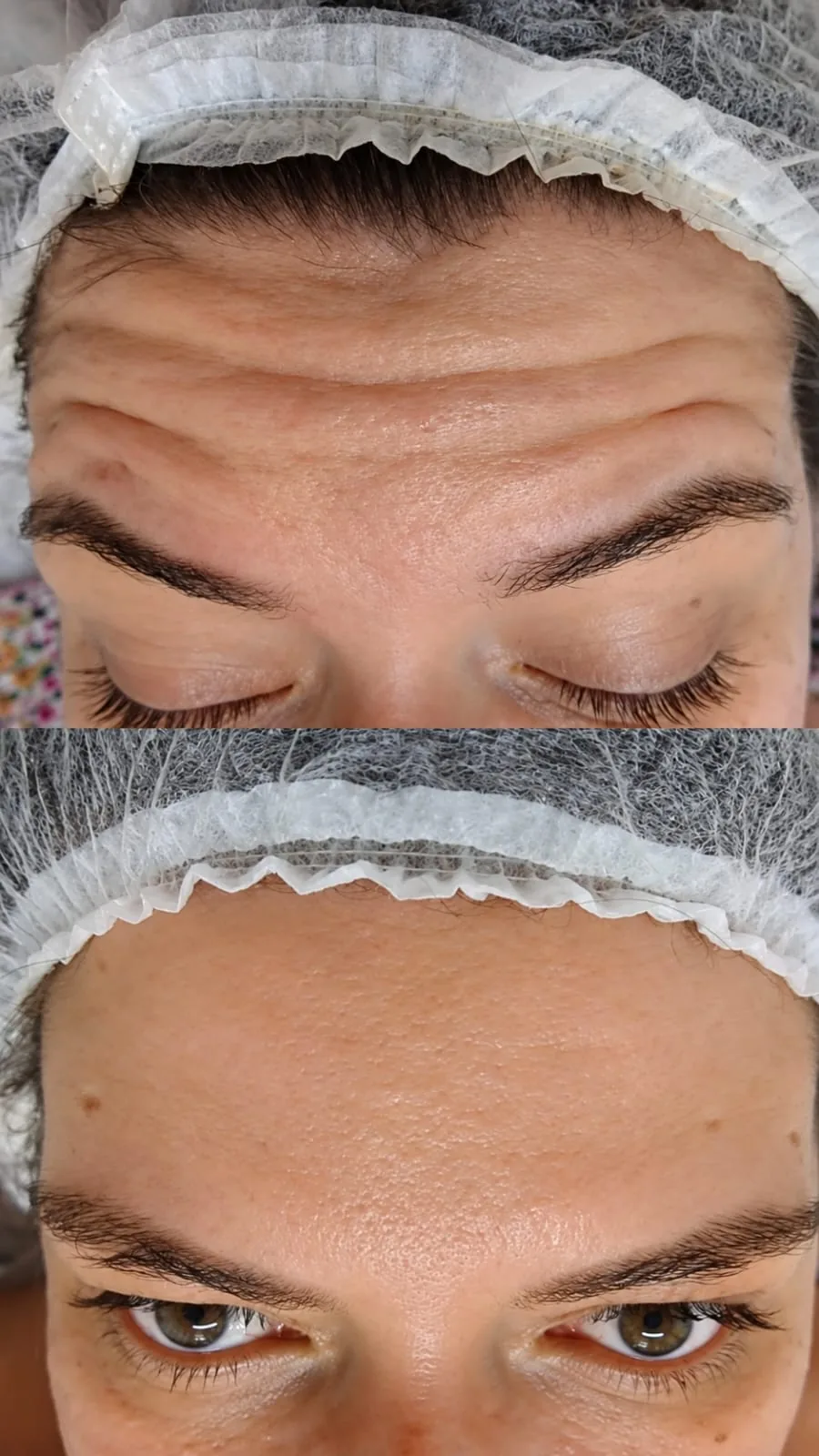 Antes e depois de suavização de linhas de expressão